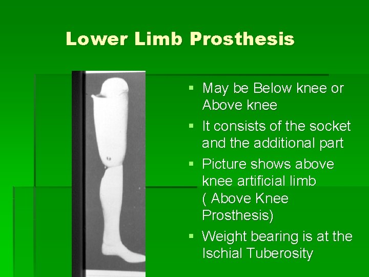 Lower Limb Prosthesis § May be Below knee or Above knee § It consists