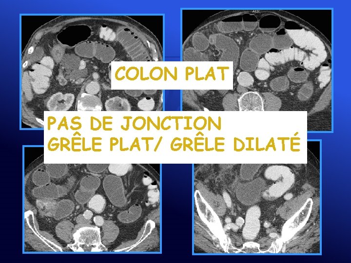 COLON PLAT PAS DE JONCTION GRÊLE PLAT/ GRÊLE DILATÉ 