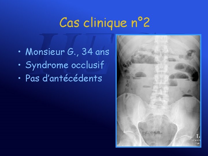 Cas clinique n° 2 • Monsieur G. , 34 ans • Syndrome occlusif •