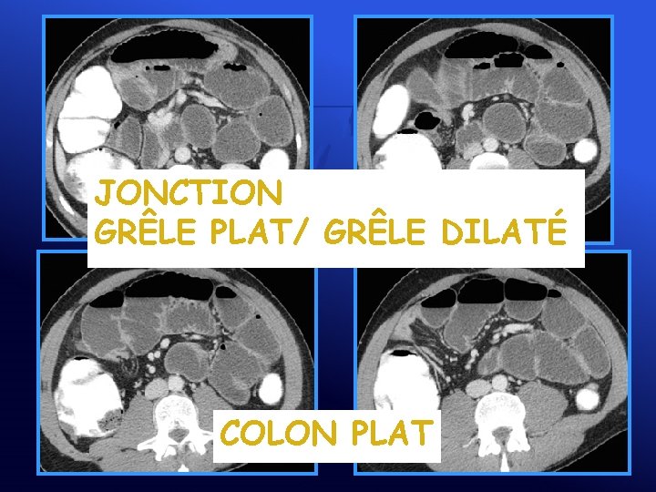 JONCTION GRÊLE PLAT/ GRÊLE DILATÉ COLON PLAT 