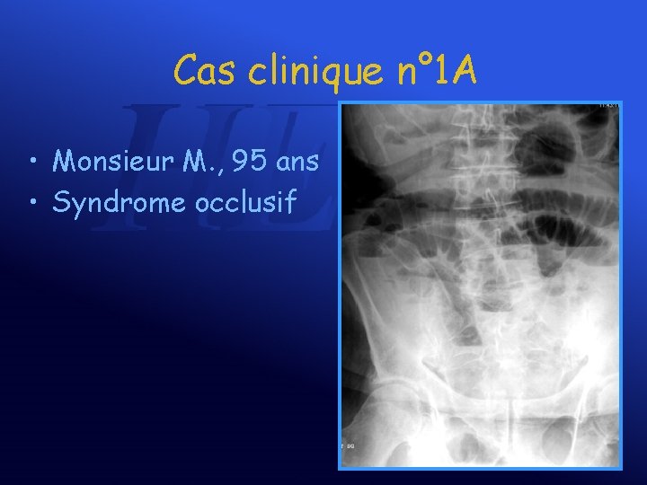 Cas clinique n° 1 A • Monsieur M. , 95 ans • Syndrome occlusif