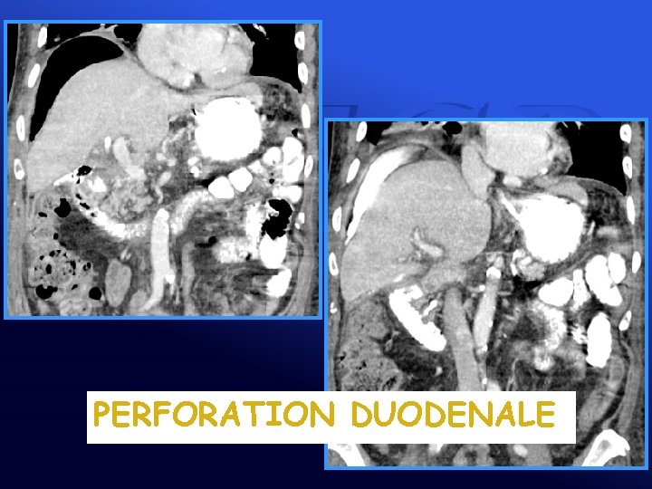 PERFORATION DUODENALE 