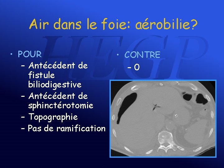 Air dans le foie: aérobilie? • POUR – Antécédent de fistule biliodigestive – Antécédent