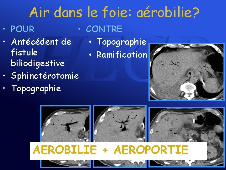 Air dans le foie: aérobilie? • POUR • CONTRE • Antécédent de • Topographie