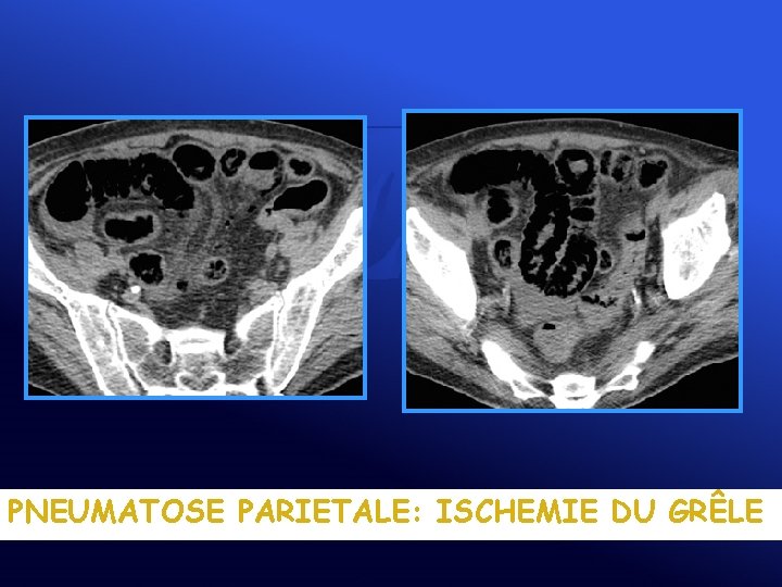 PNEUMATOSE PARIETALE: ISCHEMIE DU GRÊLE 