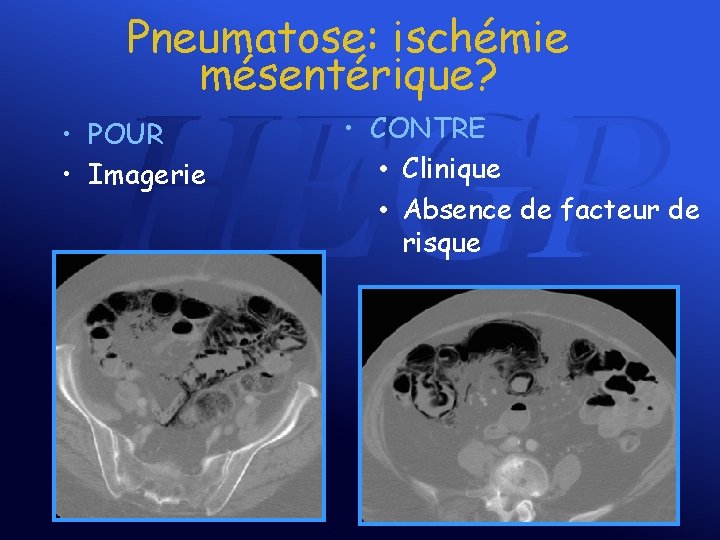 Pneumatose: ischémie mésentérique? • POUR • Imagerie • CONTRE • Clinique • Absence de