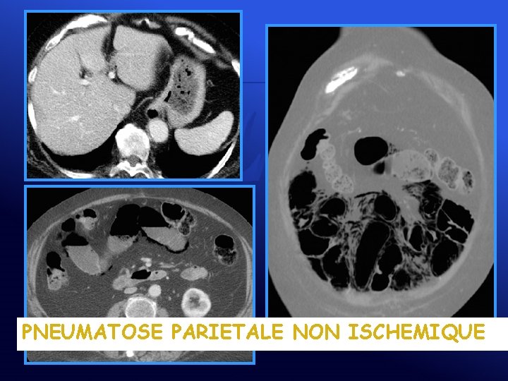 PNEUMATOSE PARIETALE NON ISCHEMIQUE 