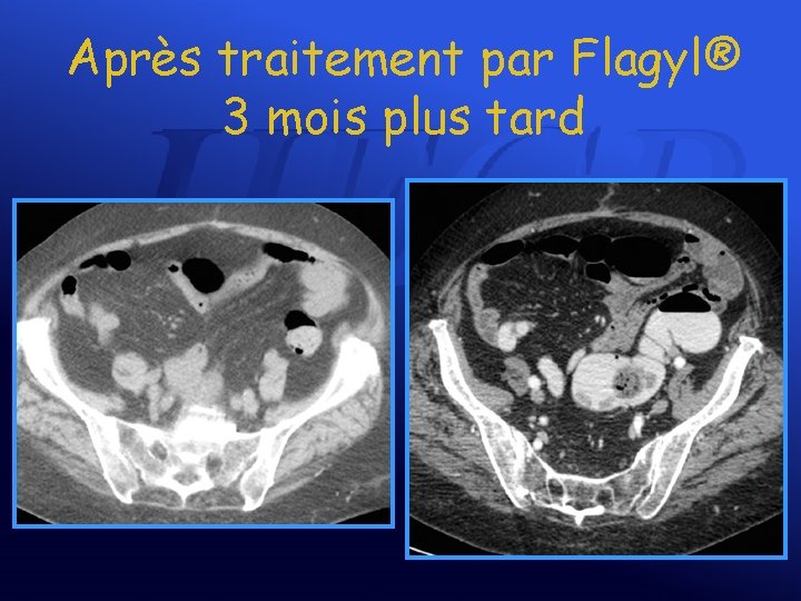 Après traitement par Flagyl® 3 mois plus tard 