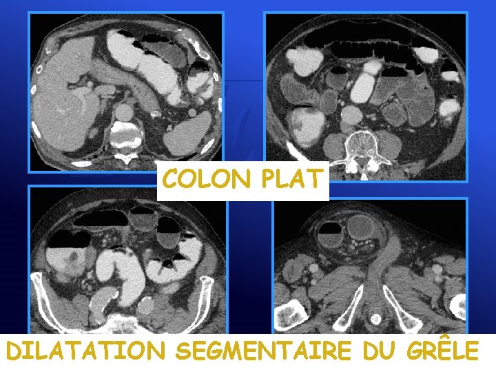 COLON PLAT DILATATION SEGMENTAIRE DU GRÊLE 