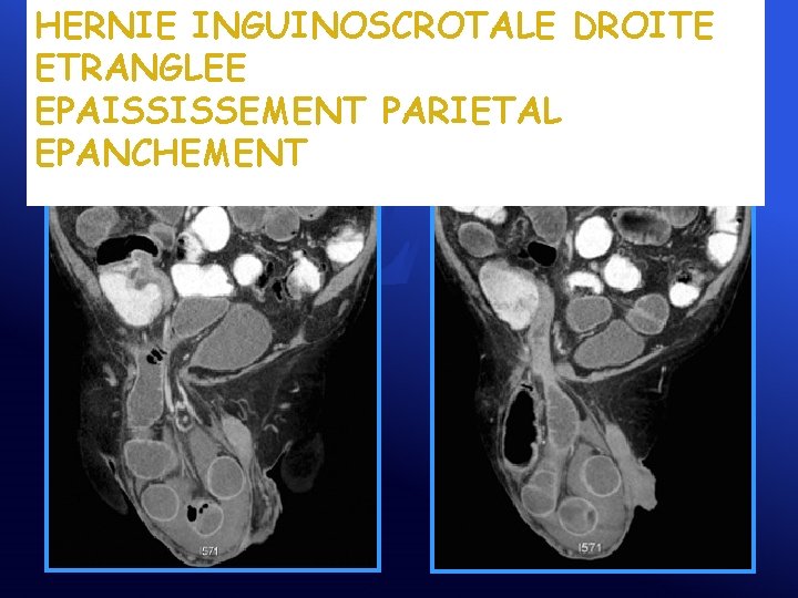 HERNIE INGUINOSCROTALE DROITE ETRANGLEE EPAISSISSEMENT PARIETAL EPANCHEMENT 