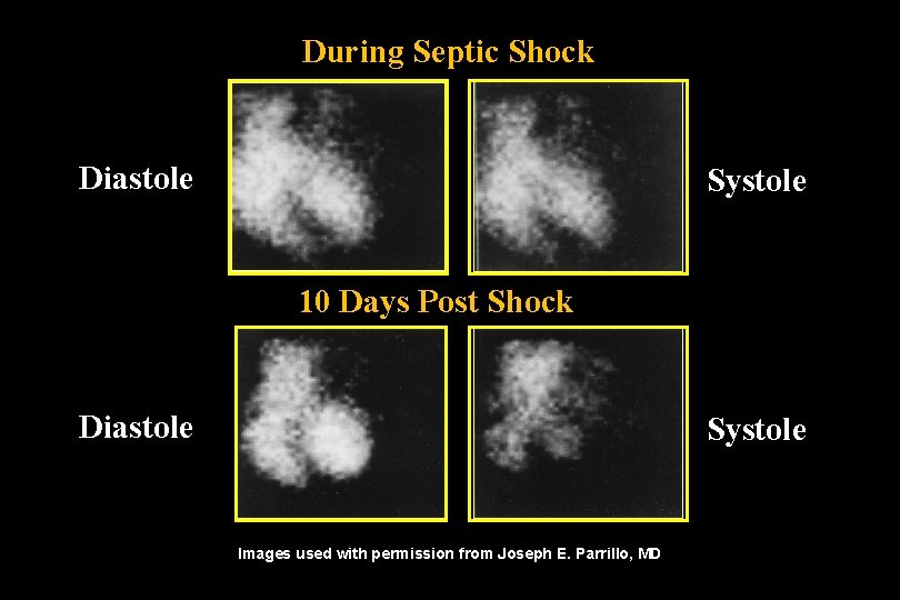 During Septic Shock Diastole Systole 10 Days Post Shock Diastole Systole Images used with