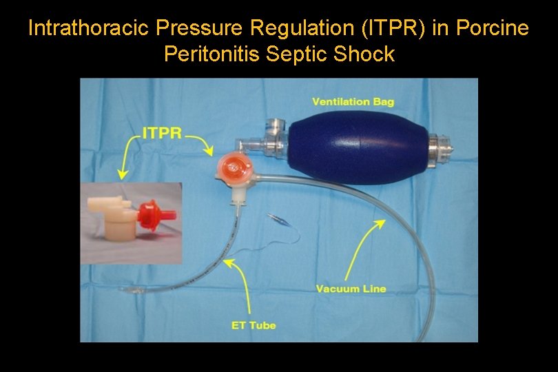 Intrathoracic Pressure Regulation (ITPR) in Porcine Peritonitis Septic Shock 