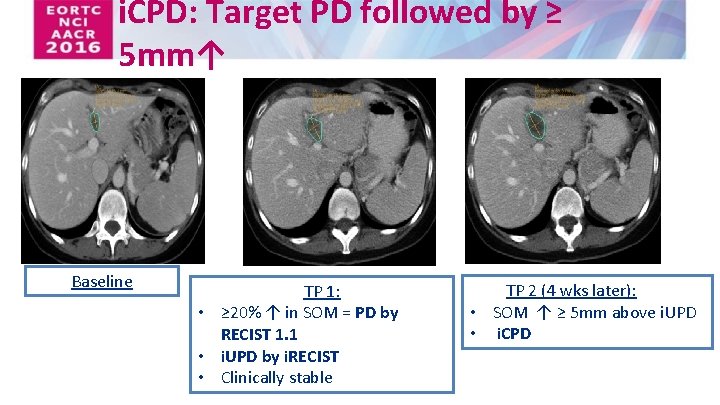 i. CPD: Target PD followed by ≥ 5 mm↑ Baseline TP 1: • ≥