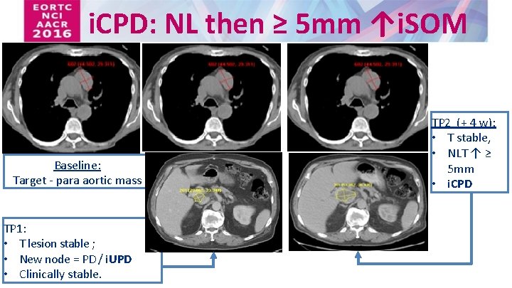 i. CPD: NL then ≥ 5 mm ↑i. SOM Baseline: Target - para aortic