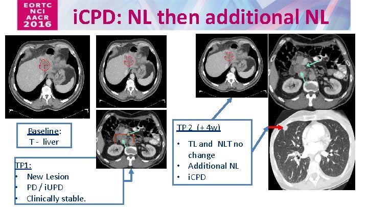 i. CPD: NL then additional NL Baseline: T - liver TP 1: • New