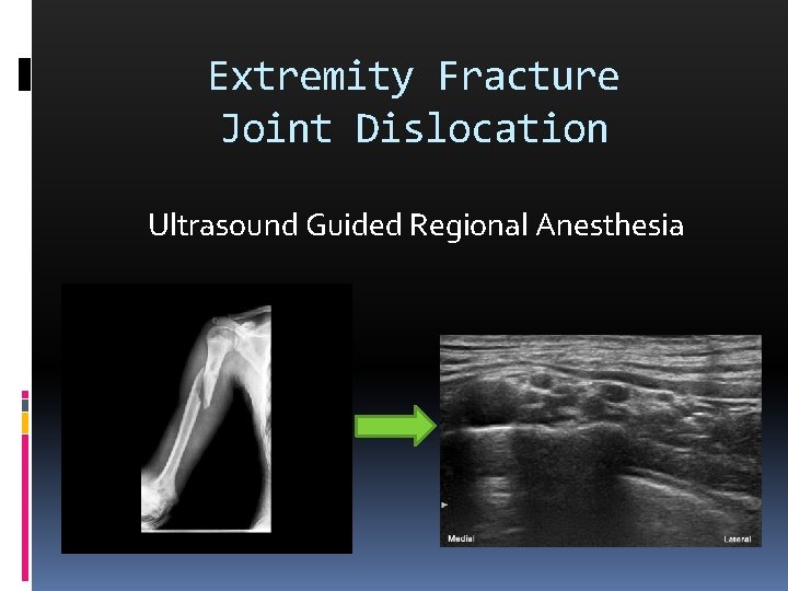 Extremity Fracture Joint Dislocation Ultrasound Guided Regional Anesthesia 