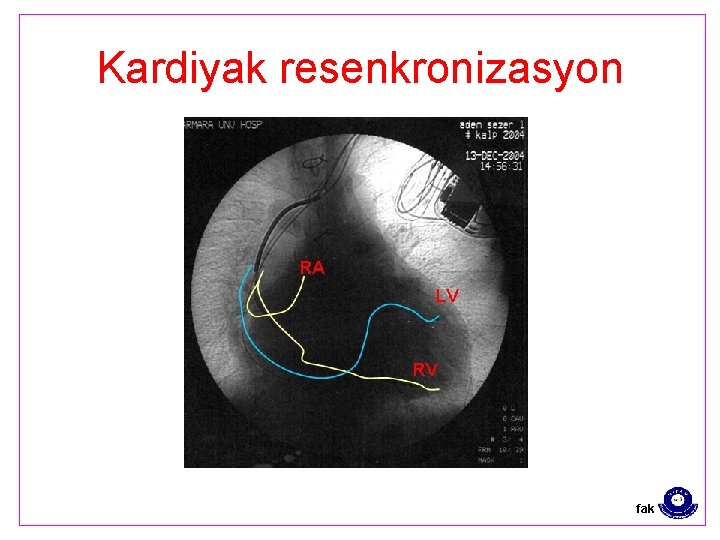 Kardiyak resenkronizasyon fak 