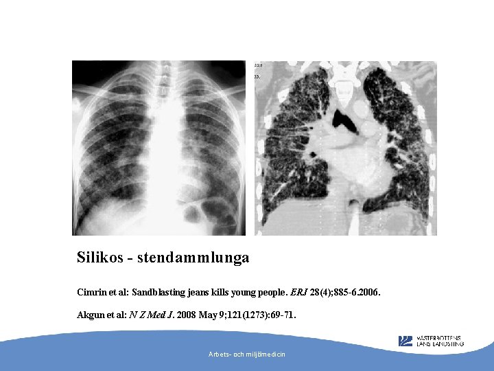 Silikos - stendammlunga Cimrin et al: Sandblasting jeans kills young people. ERJ 28(4); 885