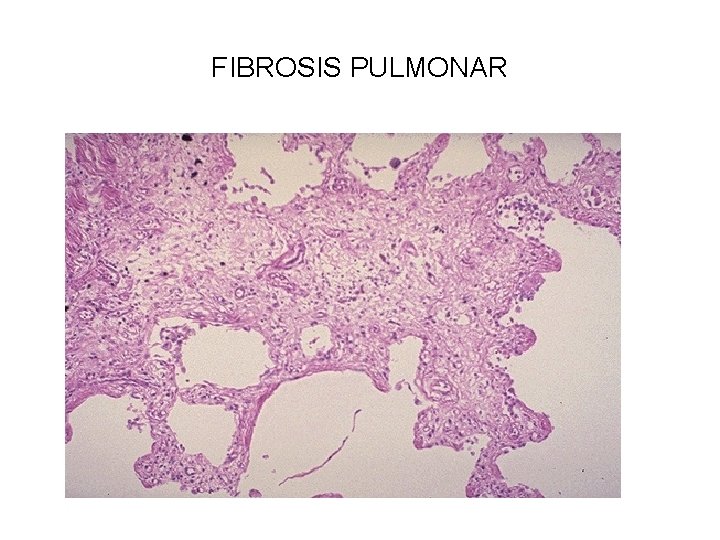 FIBROSIS PULMONAR 