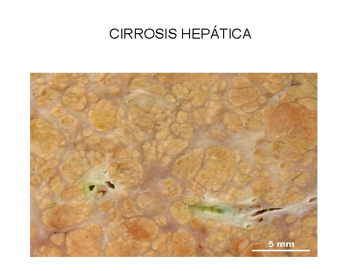 CIRROSIS HEPÁTICA 