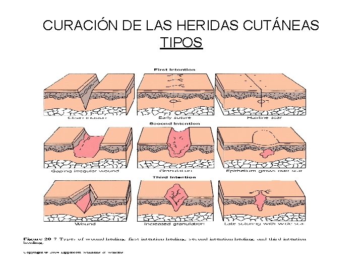 CURACIÓN DE LAS HERIDAS CUTÁNEAS TIPOS 