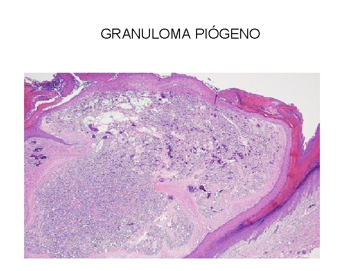 GRANULOMA PIÓGENO 