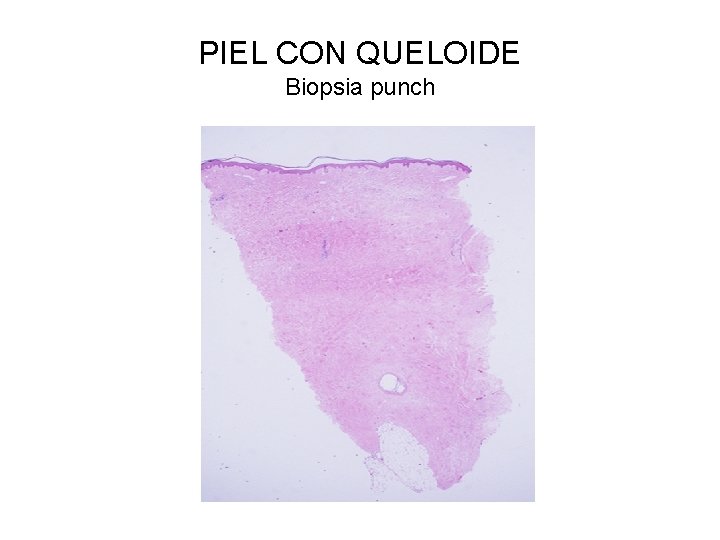 PIEL CON QUELOIDE Biopsia punch 