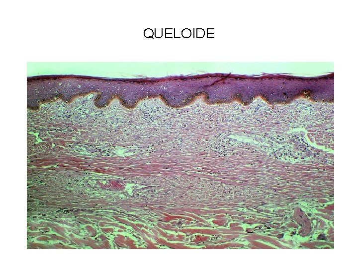 QUELOIDE 