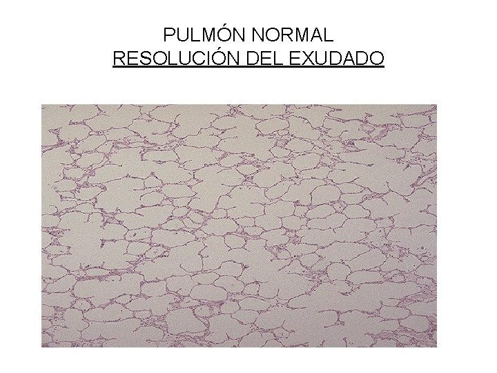 PULMÓN NORMAL RESOLUCIÓN DEL EXUDADO 