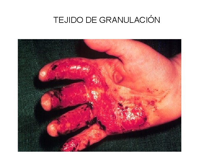 TEJIDO DE GRANULACIÓN 