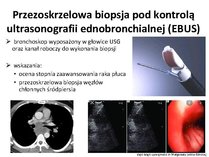 Przezoskrzelowa biopsja pod kontrolą ultrasonografii ednobronchialnej (EBUS) Ø bronchoskop wyposażony w głowice USG oraz