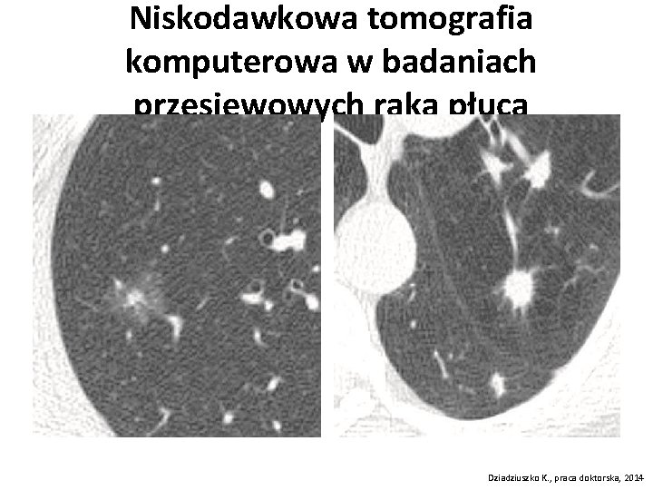 Niskodawkowa tomografia komputerowa w badaniach przesiewowych raka płuca Dziadziuszko K. , praca doktorska, 2014