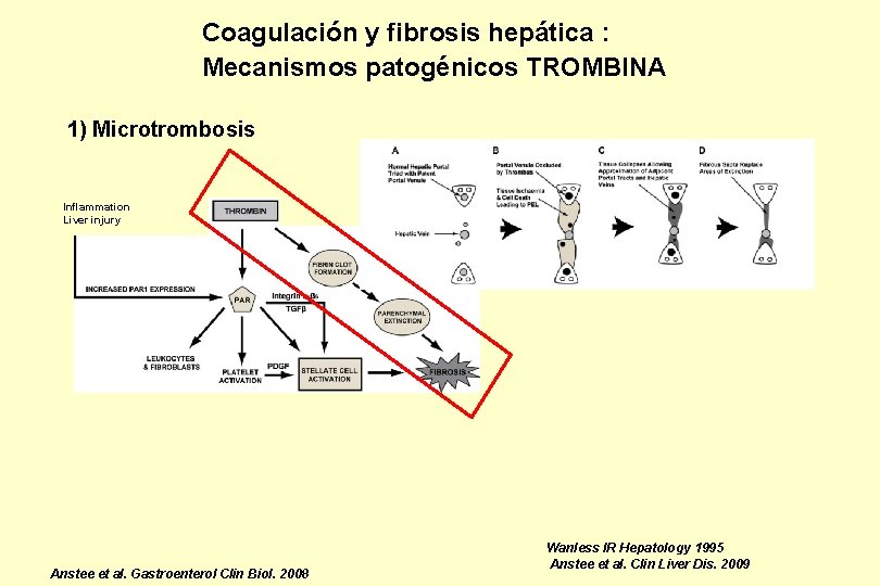 Coagulación y fibrosis hepática : Mecanismos patogénicos TROMBINA 1) Microtrombosis Inflammation Liver injury Anstee