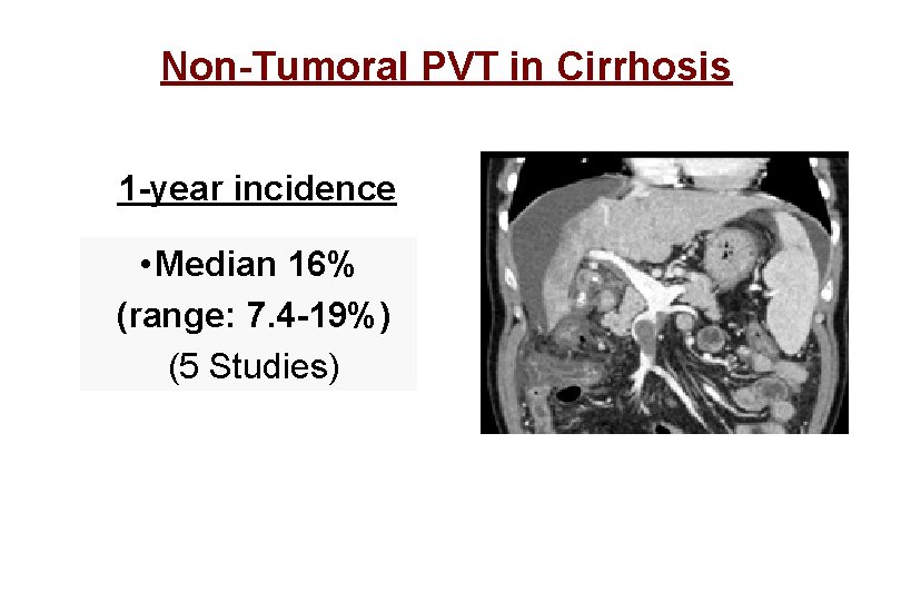 Non-Tumoral PVT in Cirrhosis 1 -year incidence • Median 16% (range: 7. 4 -19%)