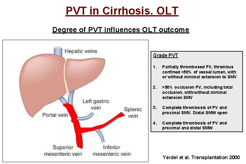 PVT in Cirrhosis. OLT Degree of PVT influences OLT outcome Grade PVT 1. Partially