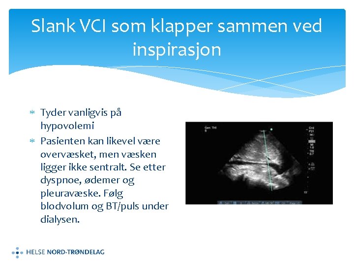 Slank VCI som klapper sammen ved inspirasjon Tyder vanligvis på hypovolemi Pasienten kan likevel
