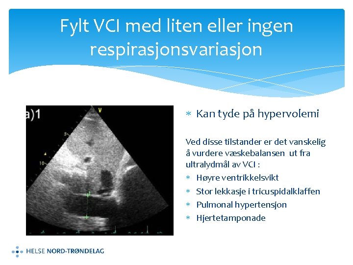 Fylt VCI med liten eller ingen respirasjonsvariasjon Kan tyde på hypervolemi Ved disse tilstander