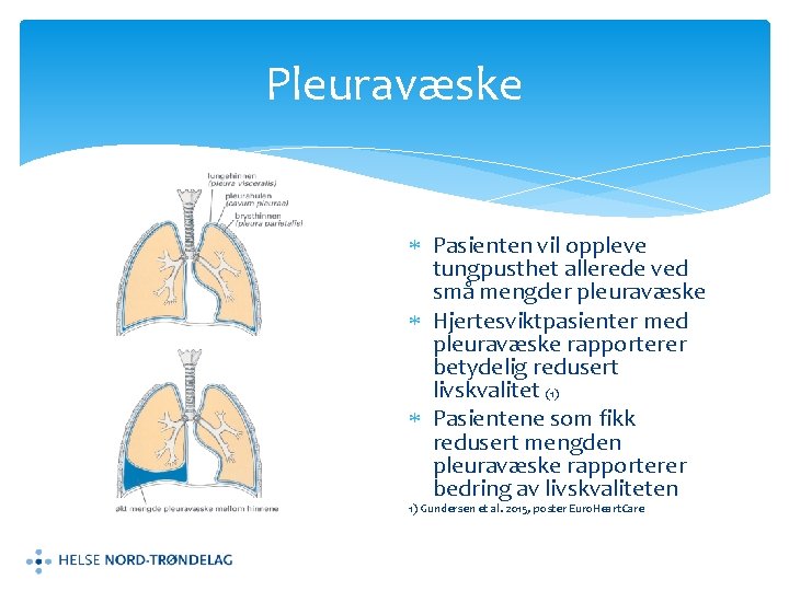 Pleuravæske Pasienten vil oppleve tungpusthet allerede ved små mengder pleuravæske Hjertesviktpasienter med pleuravæske rapporterer