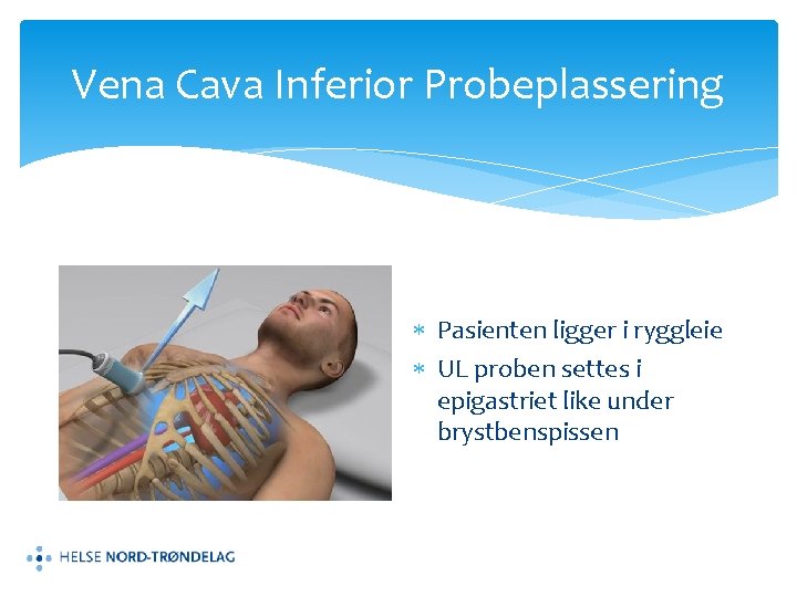 Vena Cava Inferior Probeplassering Pasienten ligger i ryggleie UL proben settes i epigastriet like