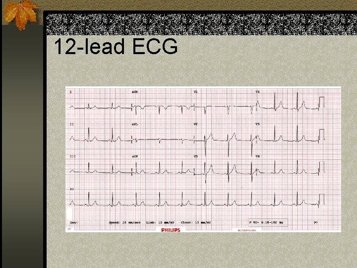 12 -lead ECG 