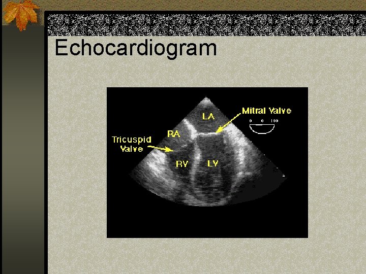Echocardiogram 