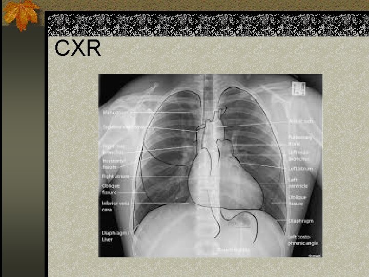 CXR 
