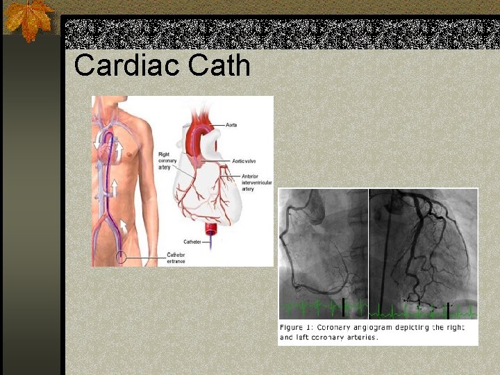 Cardiac Cath 