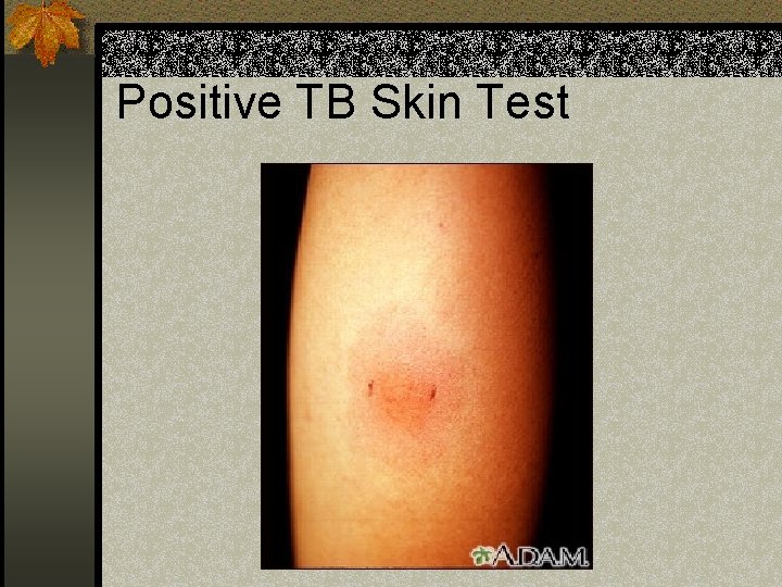 Positive TB Skin Test 