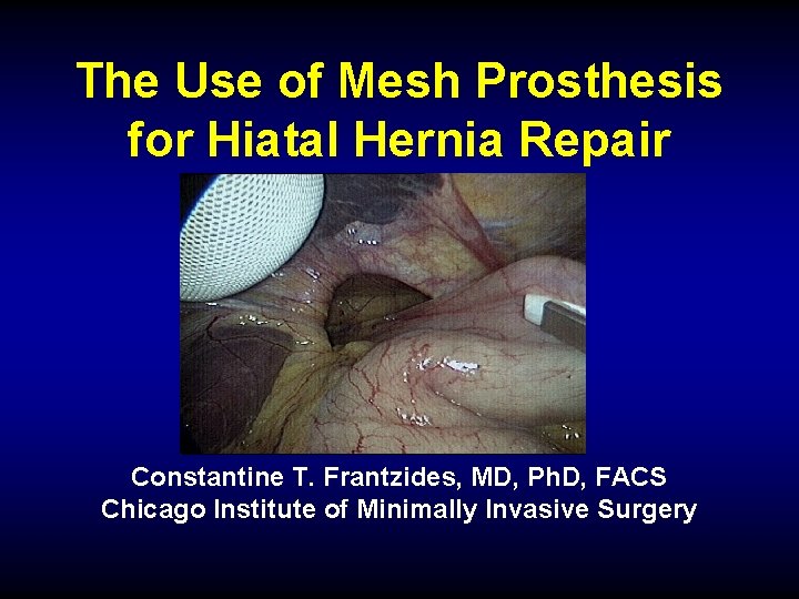 The Use of Mesh Prosthesis for Hiatal Hernia Repair Constantine T. Frantzides, MD, Ph.