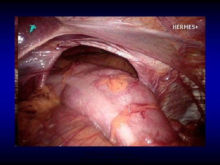 Frantzides CT, Madan AD, Carlson MA, Archives of Surgery 