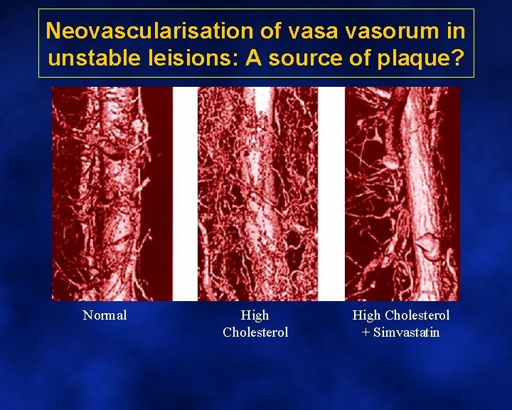 Neovascularisation of vasa vasorum in unstable leisions: A source of plaque? Normal High Cholesterol