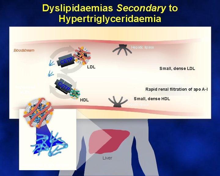 Dyslipidaemias Secondary to Hypertriglyceridaemia Hepatic lipase Bloodstream P CET Increased VLDL Small, dense LDL