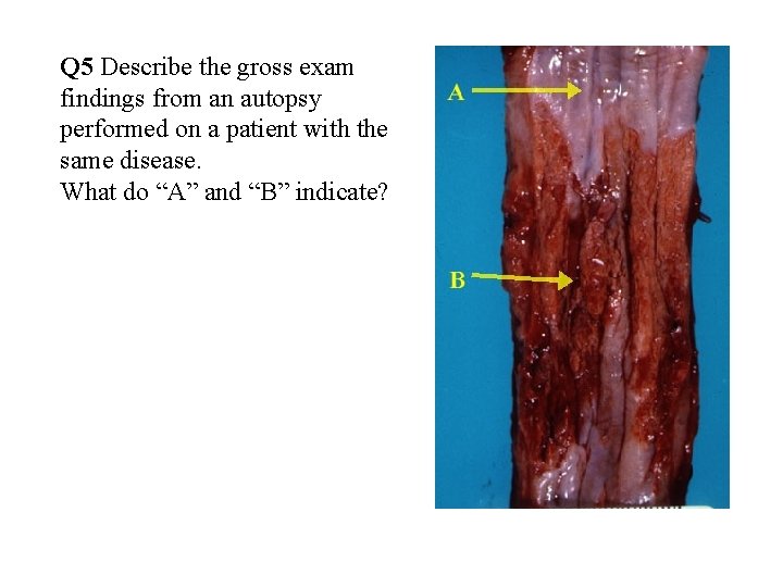 Q 5 Describe the gross exam findings from an autopsy performed on a patient