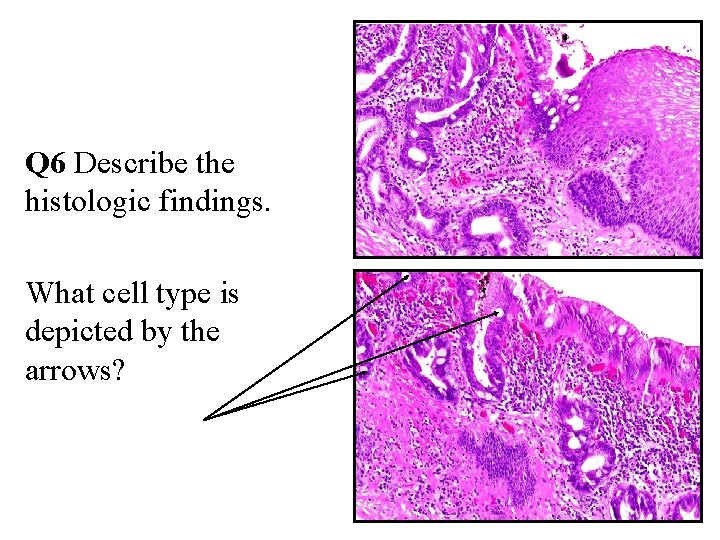 Q 6 Describe the histologic findings. What cell type is depicted by the arrows?